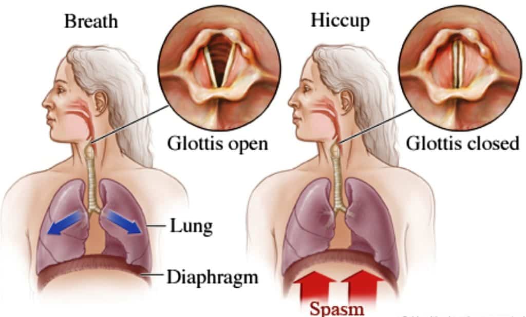 How Do You Stop Diaphragm Hiccups?